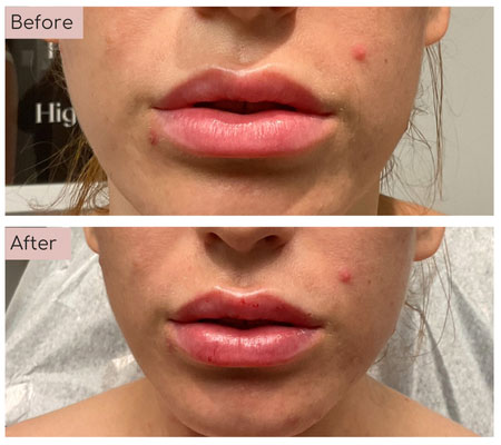 lip fillers before and afters
